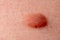Large mole close-up. Macro shot of benign skin lesion on caucasian, human skin. Proliferation of pigment derma cells.