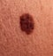 Large mole on human skin. Mole removal concept. Close-up, selective focus