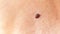 Large mole or nevus on mature skin close up macro photography with copy space. Benign lesion on the skin of a woman. Skin disease