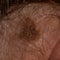 Large mole on a woman\\\'s body, medicine, health