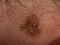 Large mole on a woman\\\'s body, medicine, health