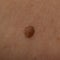 Large mole on a woman\\\'s body, medicine, health