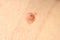 Large nevus or mole on the female body on the shoulder