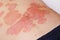 Large red inflamed scaly rash on the stomach. Acute psoriasis on the stomach in a man, severe redness on the skin, an