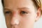 Large red rash on the nose and over the child\\\'s eye - dermatolonia, infection, herpes, mucous membrane, selective focus