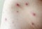 Large spots and pimples acne on the body - adult body with chickenpox. man with Chickenpox, Varicella, Varicella Zoster Virus