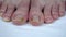 Large uncut toenails with fungus. The man has yellow toenails. Long did not cut your nails