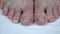 Large uncut toenails with fungus. The man has yellow toenails. Long did not cut your nails