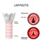 Laryngitis. normal and Inflamed larynx