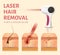 Laser Hair Removal Illustration Burnt Follicles.