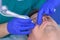 Laser removal of papillomas on man eye skin, surgeon make surgery, face closeup.
