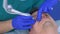 Laser removal of papillomas on man eye skin, surgeon make surgery, face closeup.