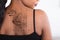 Laser Tattoo Removal On Woman`s Back