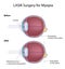 Lasik eye surgery for myopia