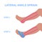 Lateral ankle sprain. Correct kinesiology taping.