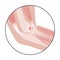 Lateral epicondylitis tennis elbow