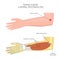 Lateral Epicondylitis or tennis elbow