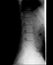 Lateral Lumbar Curve