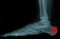 Lateral x-ray of foot and ankle. the film show normal bone and joint. the patient has Achilles tendinitis and retrocalcaneal