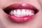 Laughing woman mouth with great teeth. Perfect smile after bleaching. Dental care and whitening teeth. Healthy smile