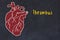 Learning cardio system concept. Chalk drawing of human heart and inscription Thrombus