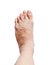 Left bunion - hallux valgus on white background and clipping pat