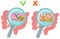 On the left is intestine with normal microflora, on the right is a poor composition of microflora with pathogenic