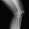 Left knee joint x-ray of mature female with osteoarthritis