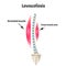Left-sided scoliosis. Levoscoliosis. Muscles and spine. Spinal curvature in scoliosis. Infographics. Vector illustration
