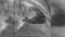 Left ventricle filling with catheter contrast agent, cardiac xray function assessment