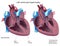 Left ventricular hypertrophy