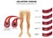 Leg artery disease, Atherosclerosis