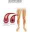 Leg artery disease, Atherosclerosis