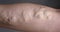 leg with varicose vein closeup