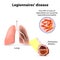 Legionnaires disease or legionellosis, Legion fever is a form o