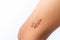 The legs of an Asian boy are scarred, convex and hard. Caused by surgical wounds and stitches,Isolate white background,Having a bu