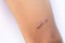 The legs of an Asian boy are scarred, convex and hard. Caused by surgical wounds and stitches,Isolate white background,The legs of