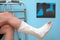 Legs of a man with a broken leg on a blue background.  X-ray image of ankle fracture , broken ankle , pott fracture fix by open