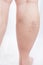 Legs of a thick woman with varicose veins overweight, obesity