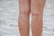 Legs of women, scars and varicose veins.