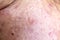 Lesions skin caused by acne on the face in the clinic.