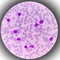 Leukemia. blood cells, blast cells and immature leukocytic cells in chronic lymphocytic leukemia