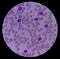 Leukemia. blood cells, blast cells and immature leukocytic cells in chronic lymphocytic leukemia