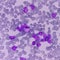 Leukemia. blood cells, blast cells and immature leukocytic cells in chronic lymphocytic leukemia, prolymphocytic leukemia