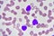 Leukemia cells