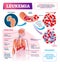 Leukemia vector illustration. Labeled educational blood cancer infographic.