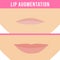 Lip augmentation effects