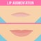 Lip augmentation effects