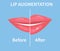 Lip Augmentation. Before and after lip filler injections. Vector illustration