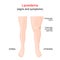 Lipoedema or Lipedema